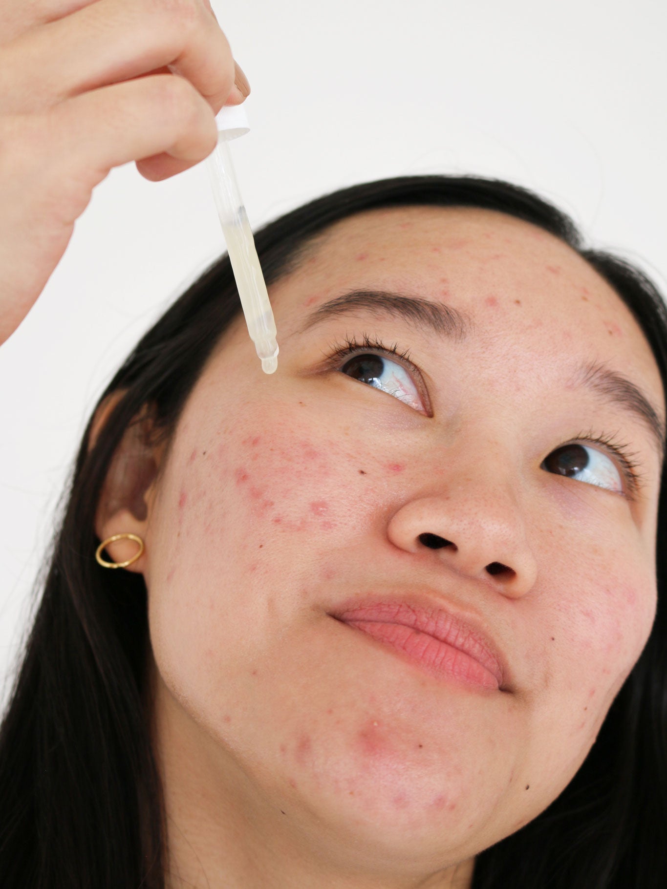 postbiotic-acne-serum-711739.jpg